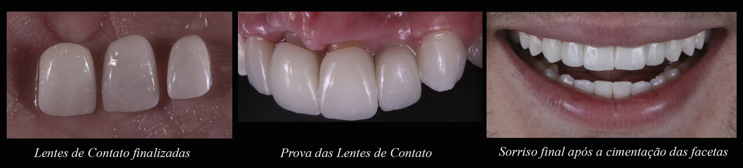 Inicial x Final em casos clínicos de Faceta de Porcelana
