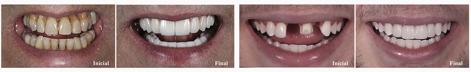 Inicial x Final em um caso clínico de implantes